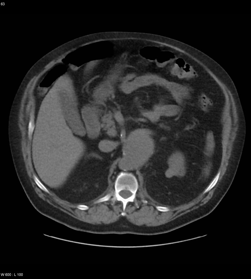 Abdominal aortic aneurysm with intramural hematoma then rupture (Radiopaedia 50278-55631 Axial non-contrast 59).jpg