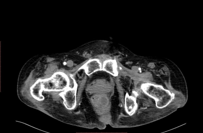 File:Abdominal aortic interposition tube graft and aneurysm thrombosis (Radiopaedia 71438-81857 Axial C+ arterial phase 247).jpg
