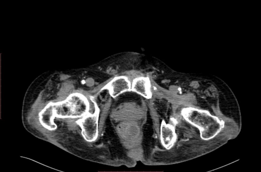 Abdominal aortic interposition tube graft and aneurysm thrombosis (Radiopaedia 71438-81857 Axial C+ arterial phase 247).jpg
