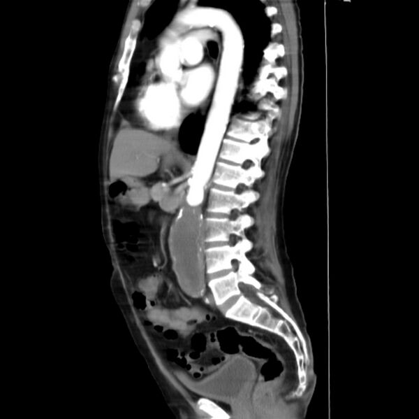 File:Abdominal aortic interposition tube graft and aneurysm thrombosis (Radiopaedia 71438-81857 Curved Sagittal C+ arterial phase 3).jpg