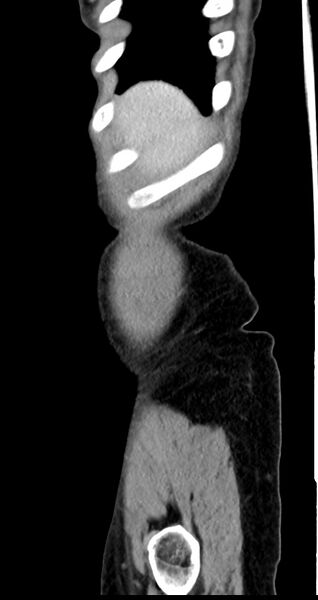 File:Abdominal wall and retroperitoneal tuberculosis (Radiopaedia 88137-104729 Sagittal C+ portal venous phase 139).jpg
