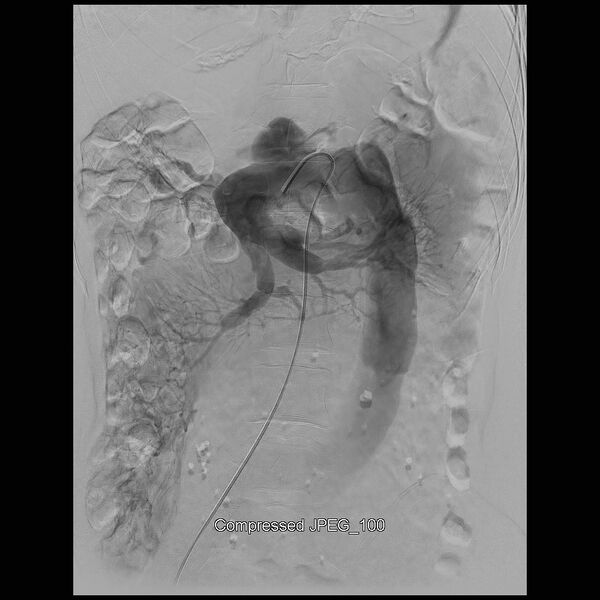 File:Abernethy malformation (Radiopaedia 42006-45462 Frontal Superior mesenteric artery 13).jpg