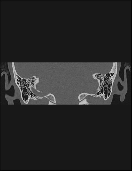 File:Aberrant right internal carotid artery (Radiopaedia 65191-74198 Coronal non-contrast 64).jpg