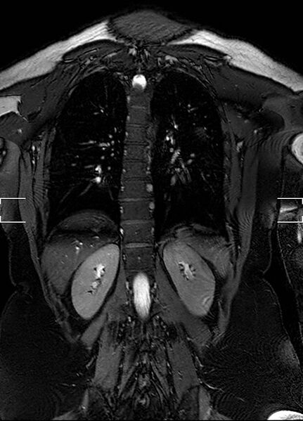 File:Aberrant right subclavian artery with background Takayasu arteritis (Radiopaedia 21423-21363 Coronal MRA 29).jpg