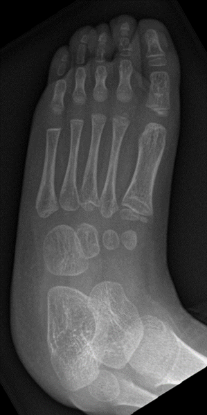 File:Absent navicular with background Kabuki syndrome (Radiopaedia 56133-62785 Oblique 1).png