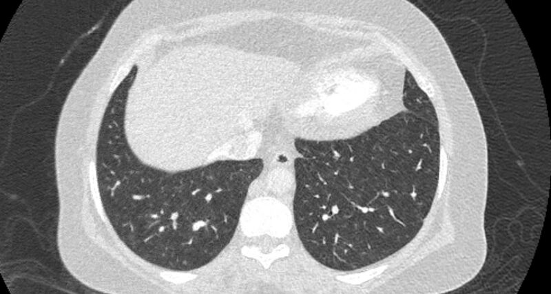 File:Accessory right inferior hepatic vein (Radiopaedia 65245-74259 Axial lung window 60).jpg