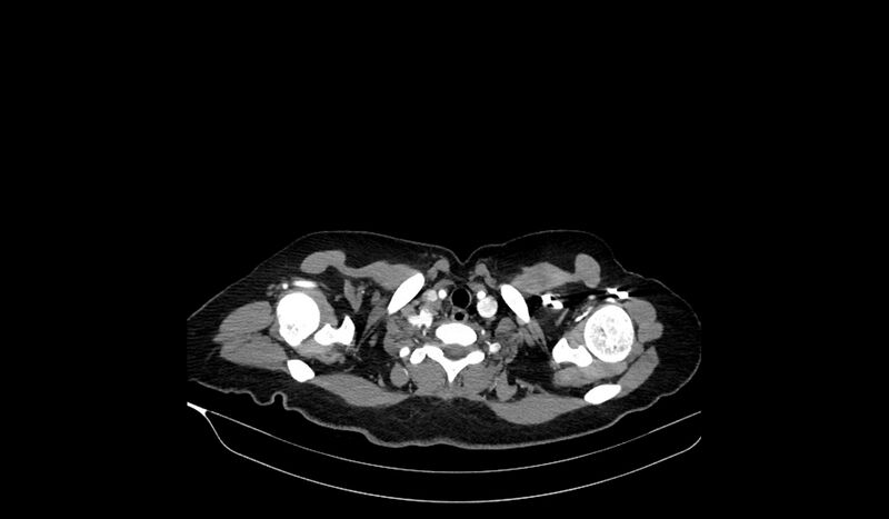 File:Acquired tracheo-esophageal fistula (Radiopaedia 51356-57103 Axial C+ arterial phase 8).jpg