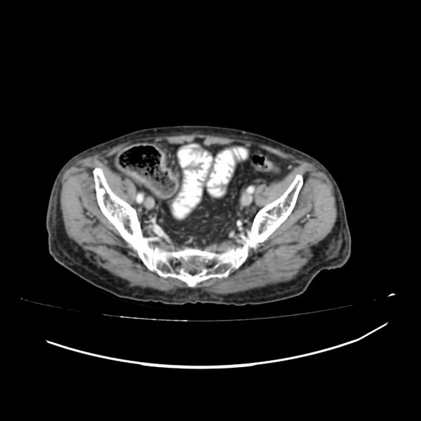 File:Acute-on-chronic Crohn disease with enteroenteric fistula (Radiopaedia 66686-75987 B 61).jpg