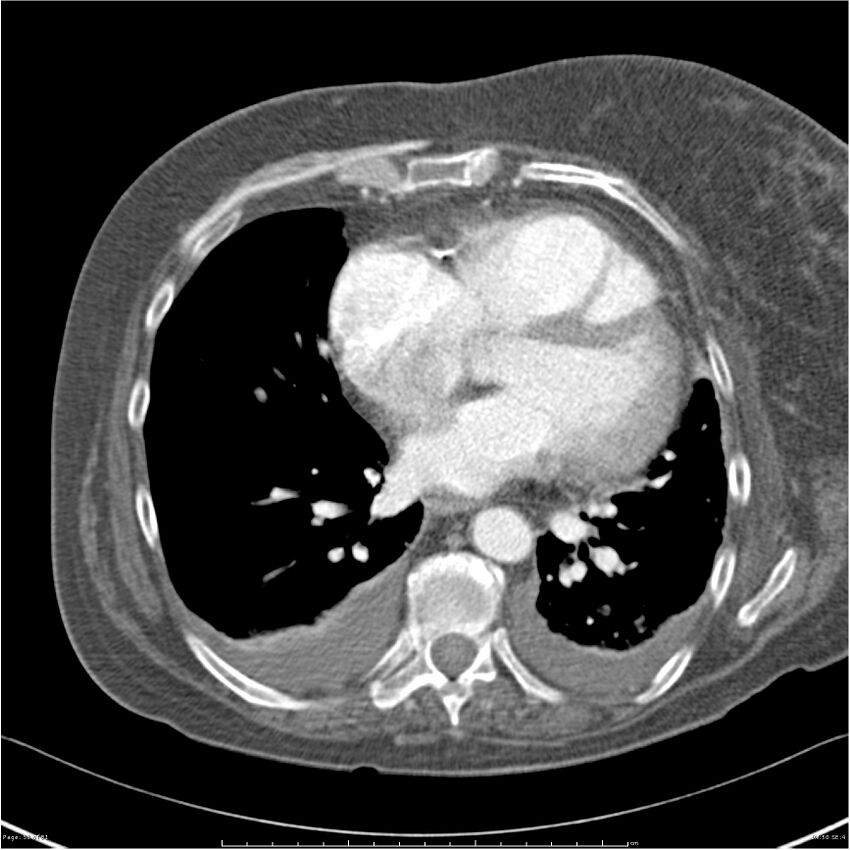 Acute-on-chronic pulmonary emboli (Radiopaedia 27925-28169 C+ CTPA 50).jpg