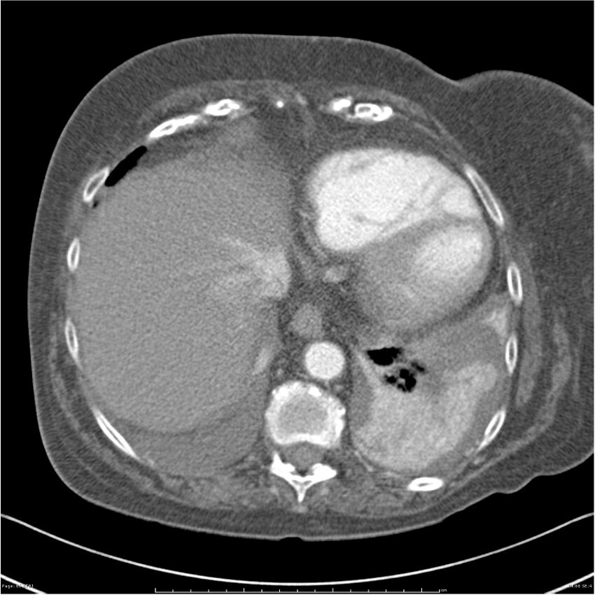 Acute-on-chronic pulmonary emboli (Radiopaedia 27925-28169 C+ CTPA 66).jpg