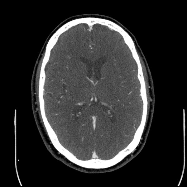 File:Acute A3 occlusion with ACA ischemic penumbra (CT perfusion) (Radiopaedia 72036-82527 Axial C+ arterial phase thins 56).jpg