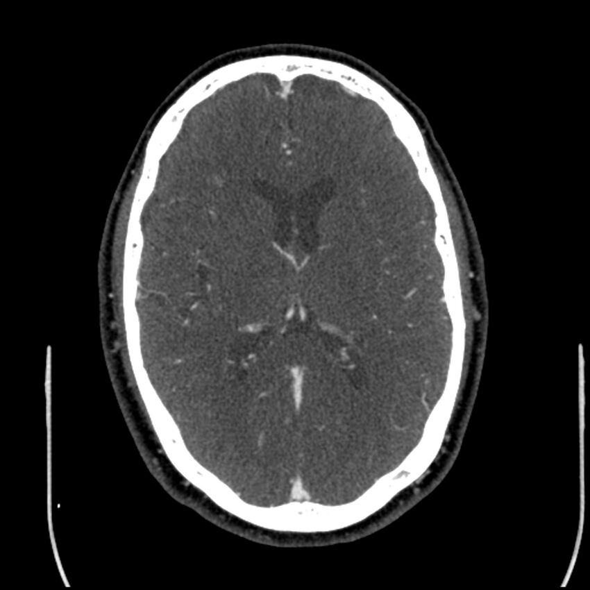 Acute A3 occlusion with ACA ischemic penumbra (CT perfusion) (Radiopaedia 72036-82527 Axial C+ arterial phase thins 56).jpg