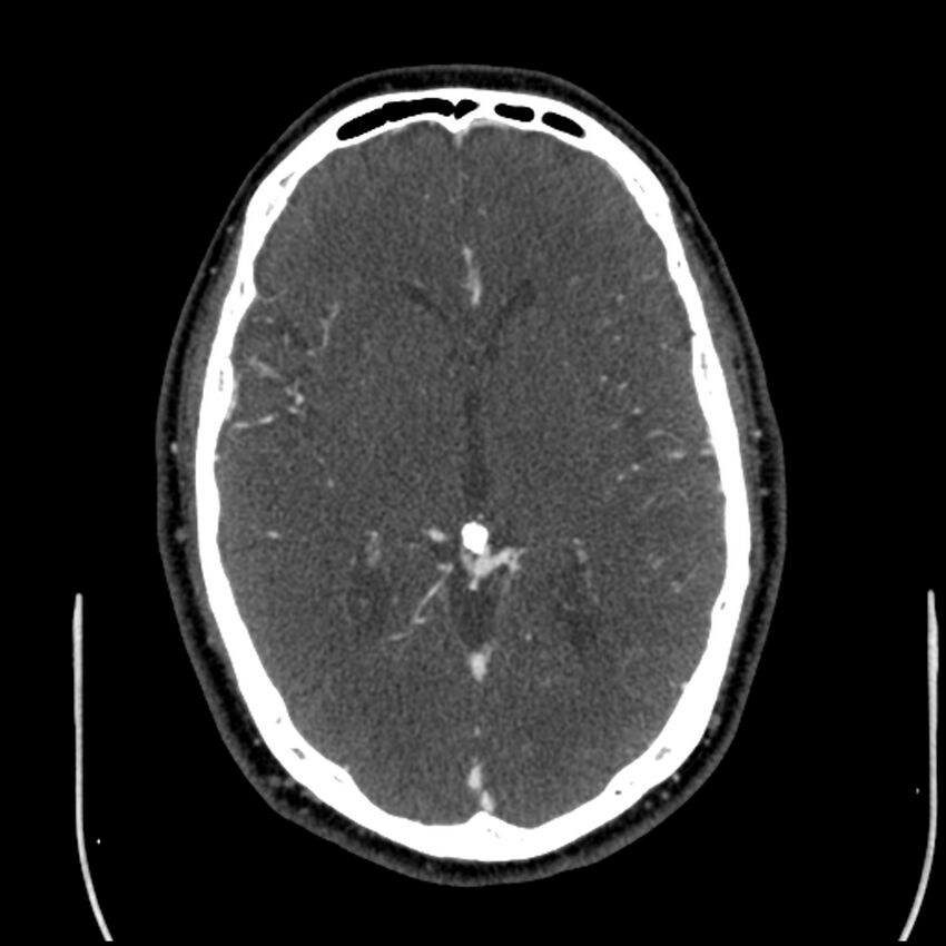 Acute A3 occlusion with ACA ischemic penumbra (CT perfusion) (Radiopaedia 72036-82527 Axial C+ arterial phase thins 74).jpg