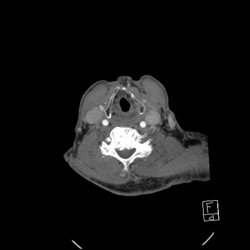 Acute ICA ischemic penumbra due to high-grade CCA stenosis (CT perfusion) (Radiopaedia 72038-82530 Axial C+ arterial phase 54).jpg