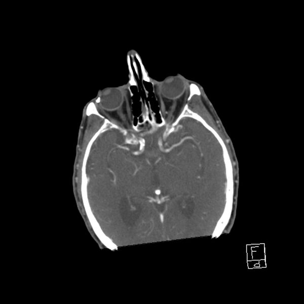 File:Acute ICA ischemic penumbra due to high-grade CCA stenosis (CT perfusion) (Radiopaedia 72038-82530 Axial C+ arterial phase 6).jpg