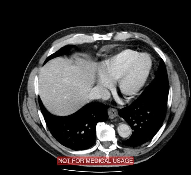File:Acute aortic dissection - Stanford type A (Radiopaedia 40661-43285 Axial C+ portal venous phase 46).jpg