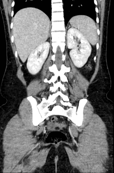 File:Acute appendicitis (Radiopaedia 22892-22918 Coronal C+ portal venous phase 42).png