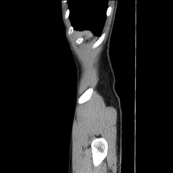 File:Acute appendicitis (Radiopaedia 27049-27227 Sagittal C+ portal venous phase 2).jpg