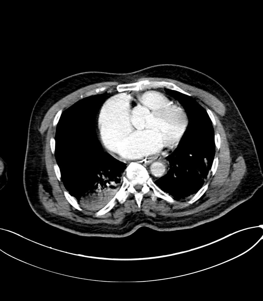 Acute arterial mesenteric ischemia (Radiopaedia 78238-90828 Axial C+ portal venous phase 8).jpg