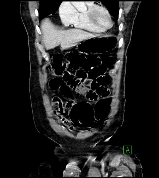 File:Acute arterial mesenteric ischemia (Radiopaedia 78238-90828 Coronal C+ portal venous phase 26).jpg