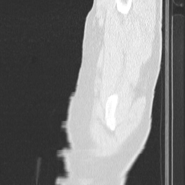 File:Acute aspiration pneumonitis (Radiopaedia 33605-34703 Sagittal lung window 2).jpg