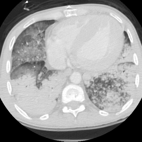 File:Acute diffuse alveolar hemorrhage (Radiopaedia 41323-44158 Axial lung window 46).jpg
