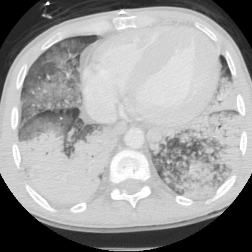 Acute diffuse alveolar hemorrhage (Radiopaedia 41323-44158 Axial lung window 46).jpg