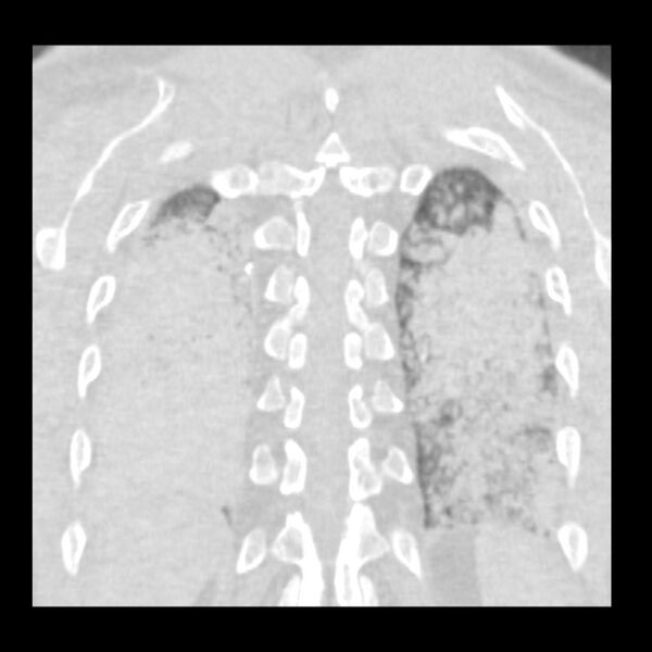 File:Acute diffuse alveolar hemorrhage (Radiopaedia 41323-44158 Coronal lung window 49).jpg