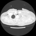 Acute heart failure (CT) (Radiopaedia 79835-93075 Axial lung window 3).png