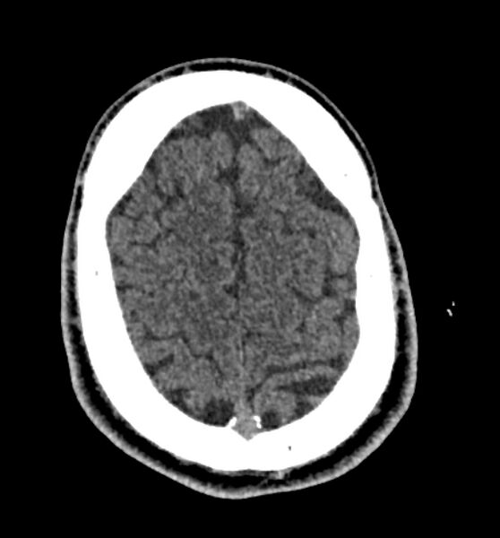 File:Acute ischemic stroke - posterior circulation territory (Radiopaedia 77670-89881 non-contrast 77).jpg