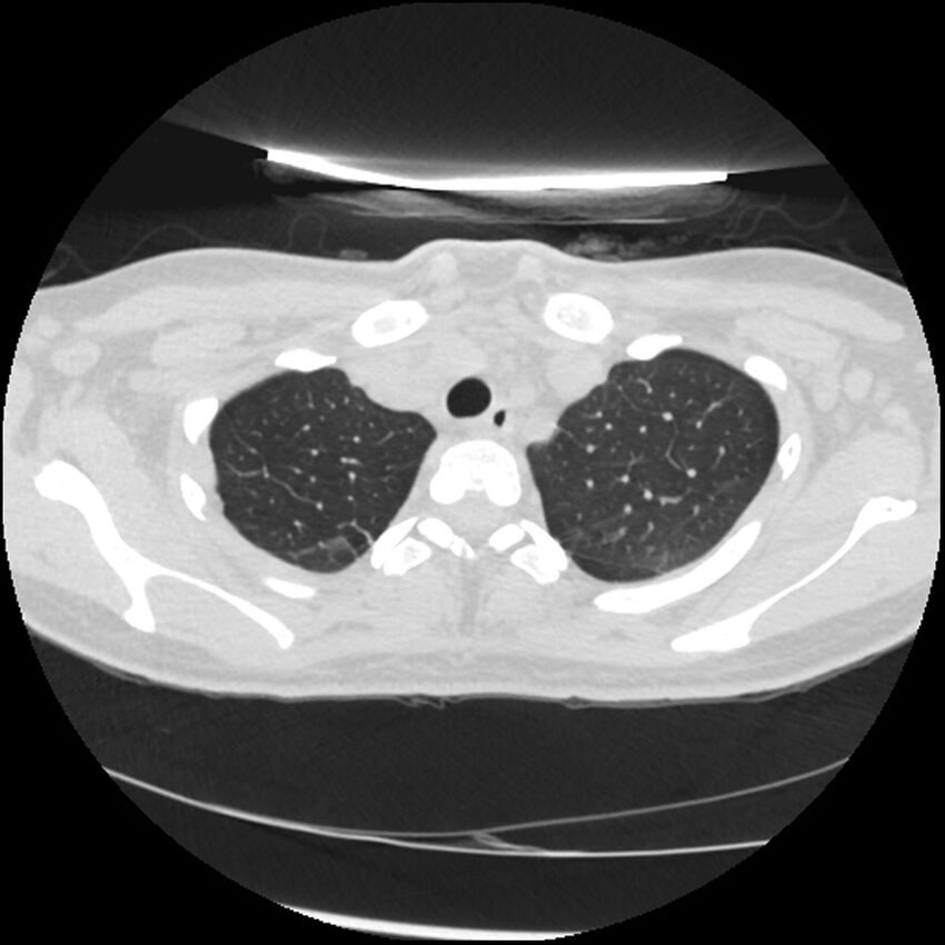 Acute lupus nephritis (Radiopaedia 45832-50107 Axial lung window 13).jpg