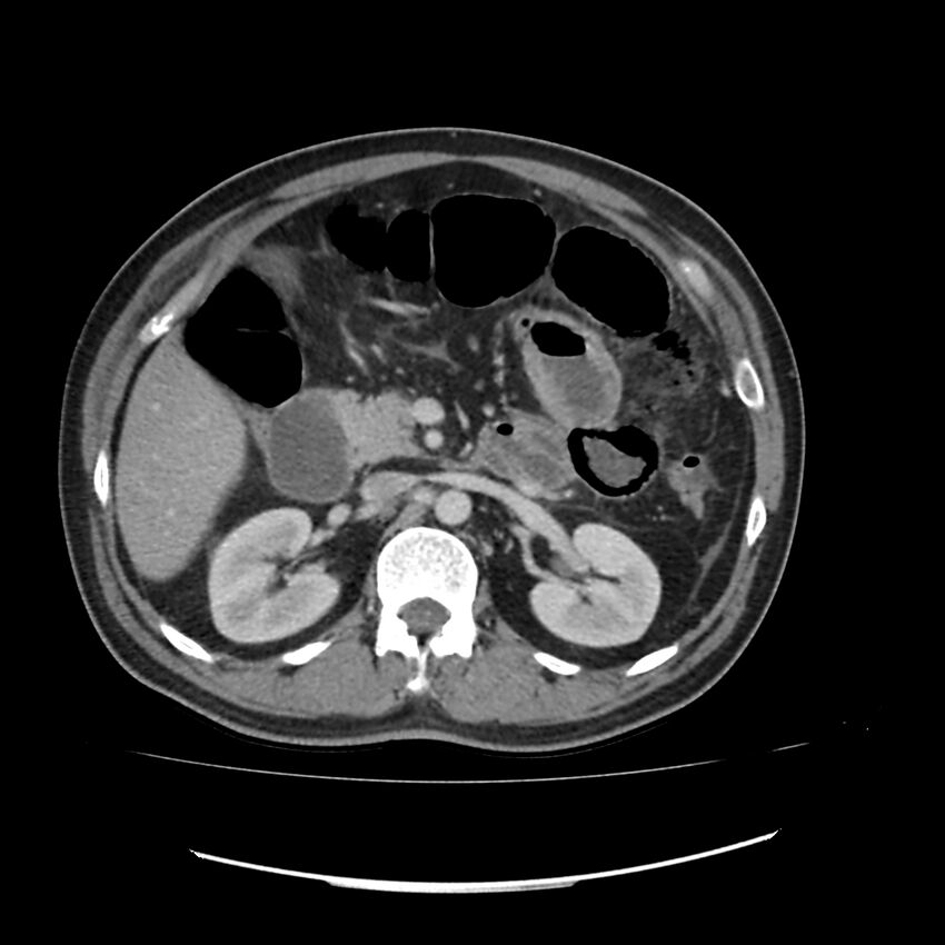 Acute mesenteric ischemia - superior mesenteric artery thrombosis (Radiopaedia 73947-84776 Axial C+ portal venous phase 39).jpg