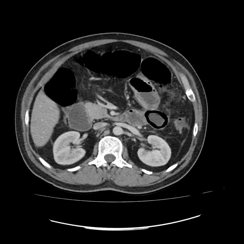 Acute mesenteric ischemia - superior mesenteric artery thrombosis (Radiopaedia 73947-84776 Axial C+ portal venous phase 42).jpg