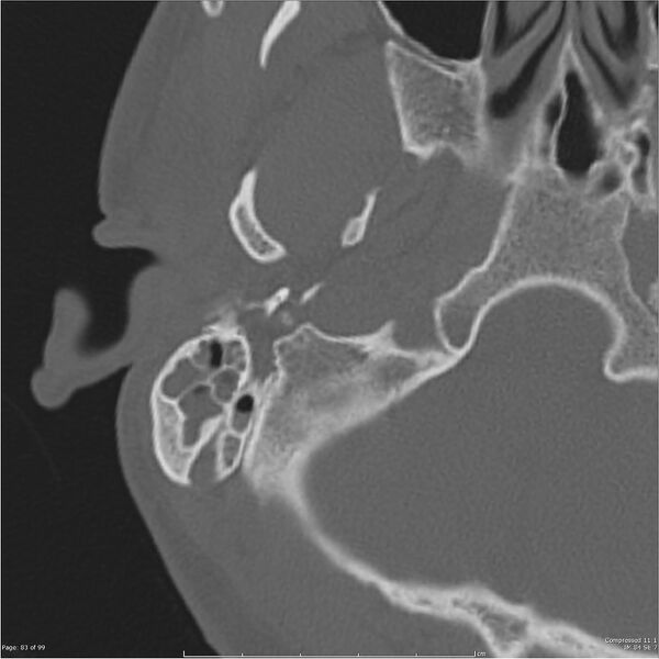 File:Acute otomastoiditis (Radiopaedia 28276-28512 Axial PTB bone window reformat 63).jpg