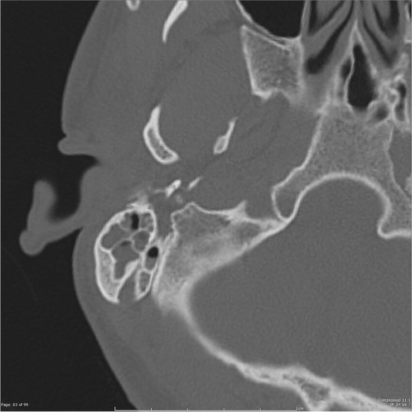 Acute otomastoiditis (Radiopaedia 28276-28512 Axial PTB bone window reformat 63).jpg