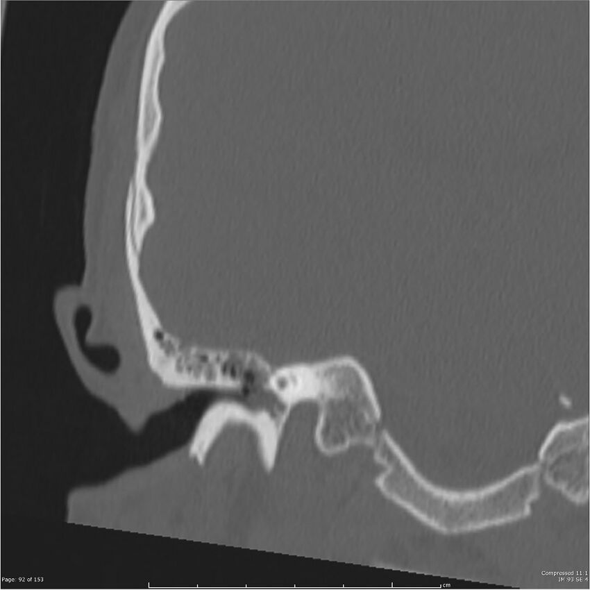 Acute otomastoiditis (Radiopaedia 28276-28512 Coronal PTB bone window reformat 23).jpg