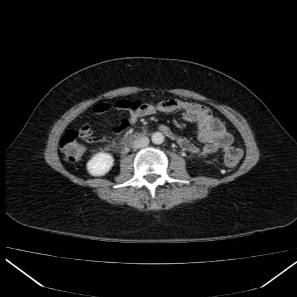 File:Acute pancreatitis - Balthazar C (Radiopaedia 26569-26714 Axial C+ portal venous phase 54).jpg