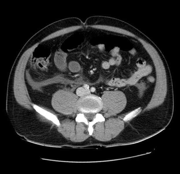 File:Acute pancreatitis - Balthazar E (Radiopaedia 23080-23110 Axial C+ portal venous phase 44).jpg