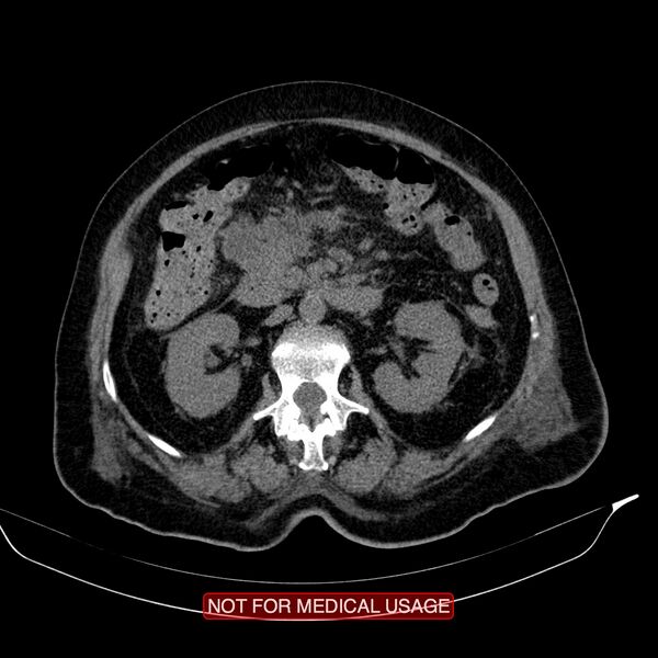 File:Acute pancreatitis with infected necrosis (Radiopaedia 26454-26585 Axial non-contrast 15).jpg