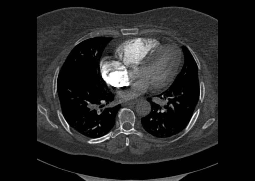 Acute pulmonary embolism (Radiopaedia 29938-30466 Axial C+ CTPA 123).jpg