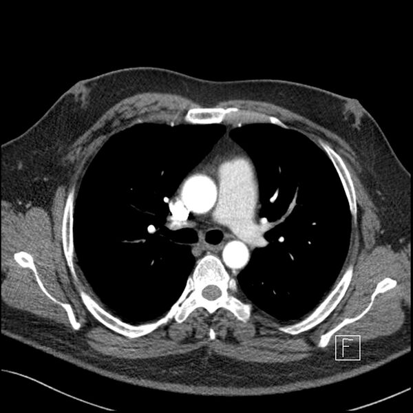 File:Acute pulmonary embolism with pulmonary infarct (Radiopaedia 73062-83768 Axial C+ CTPA 28).jpg