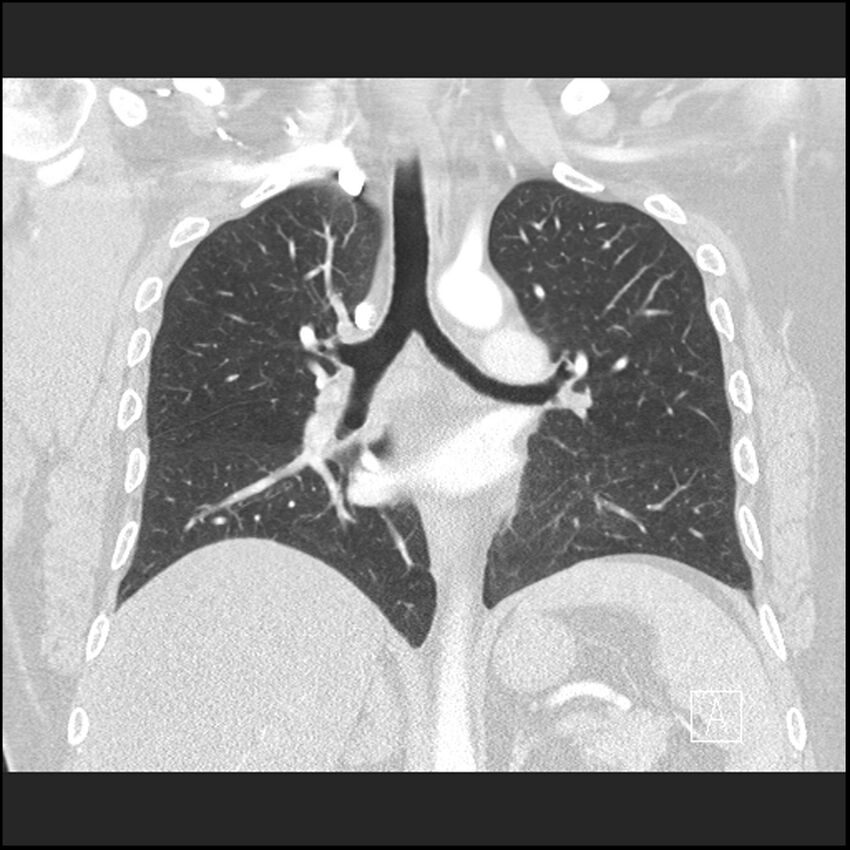 Acute pulmonary embolism with pulmonary infarct (Radiopaedia 73062-83768 Coronal lung window 43).jpg