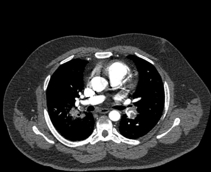 File:Acute pulmonary embolism with pulmonary infarcts (Radiopaedia 77688-89908 Axial C+ CTPA 28).jpg