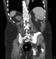 Acute renal failure post IV contrast injection- CT findings (Radiopaedia 47815-52559 Coronal C+ portal venous phase 28).jpg