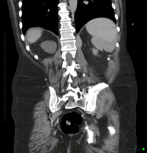 File:Acute renal failure post IV contrast injection- CT findings (Radiopaedia 47815-52559 Coronal C+ portal venous phase 28).jpg