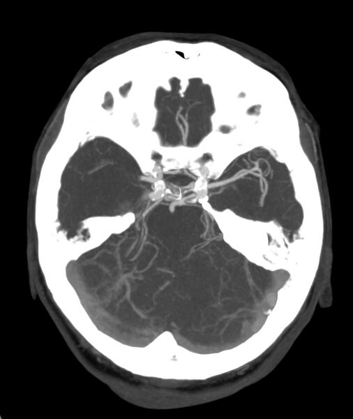 File:Acute right MCA M1 occlusion (Radiopaedia 62268-70454 Axial Phase 1 20).jpg