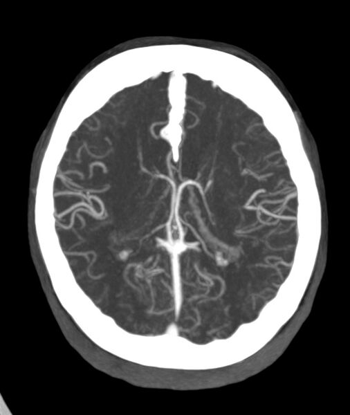 File:Acute right MCA M1 occlusion (Radiopaedia 62268-70454 Axial Phase 2 12).jpg