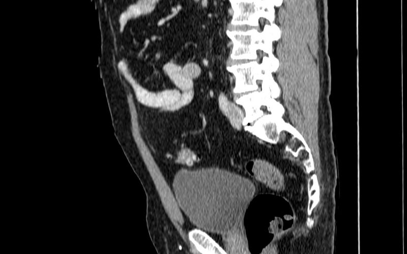 File:Acute sigmoid colon diverticulitis (Radiopaedia 55507-61976 Sagittal C+ portal venous phase 16).jpg