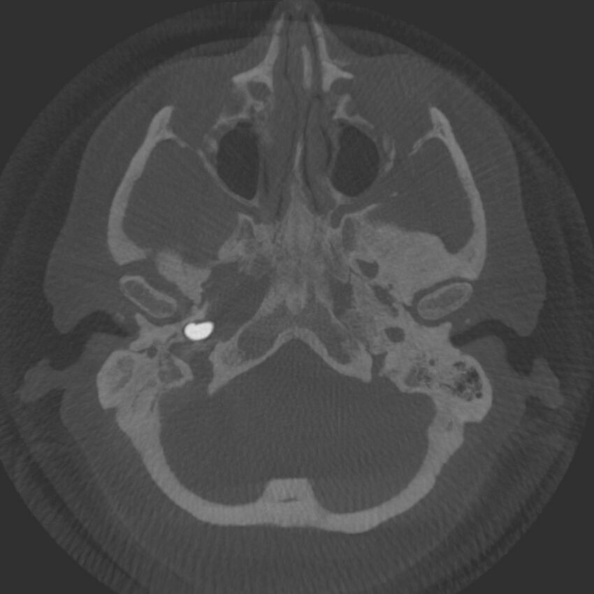 Acute subarachnoid hemorrhage and accessory anterior cerebral artery (Radiopaedia 69231-79010 Axial arterial - MIP 10).jpg