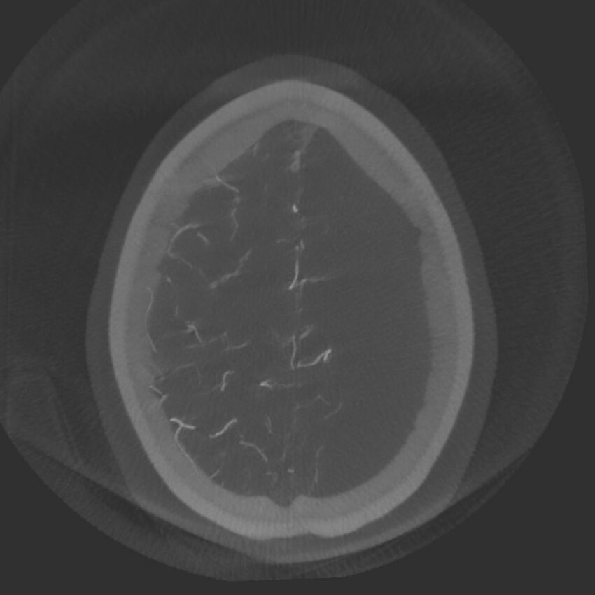 Acute subarachnoid hemorrhage and accessory anterior cerebral artery (Radiopaedia 69231-79010 Axial arterial - MIP 72).jpg